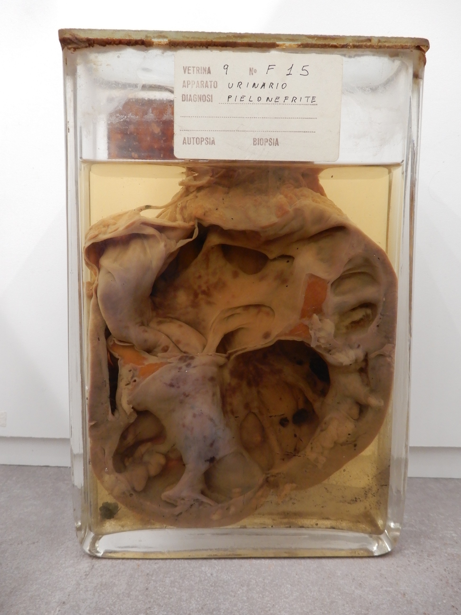 singolo reperto antropologico, preparato anatomico (morfologia alterata per patologia) (XIX-XX)