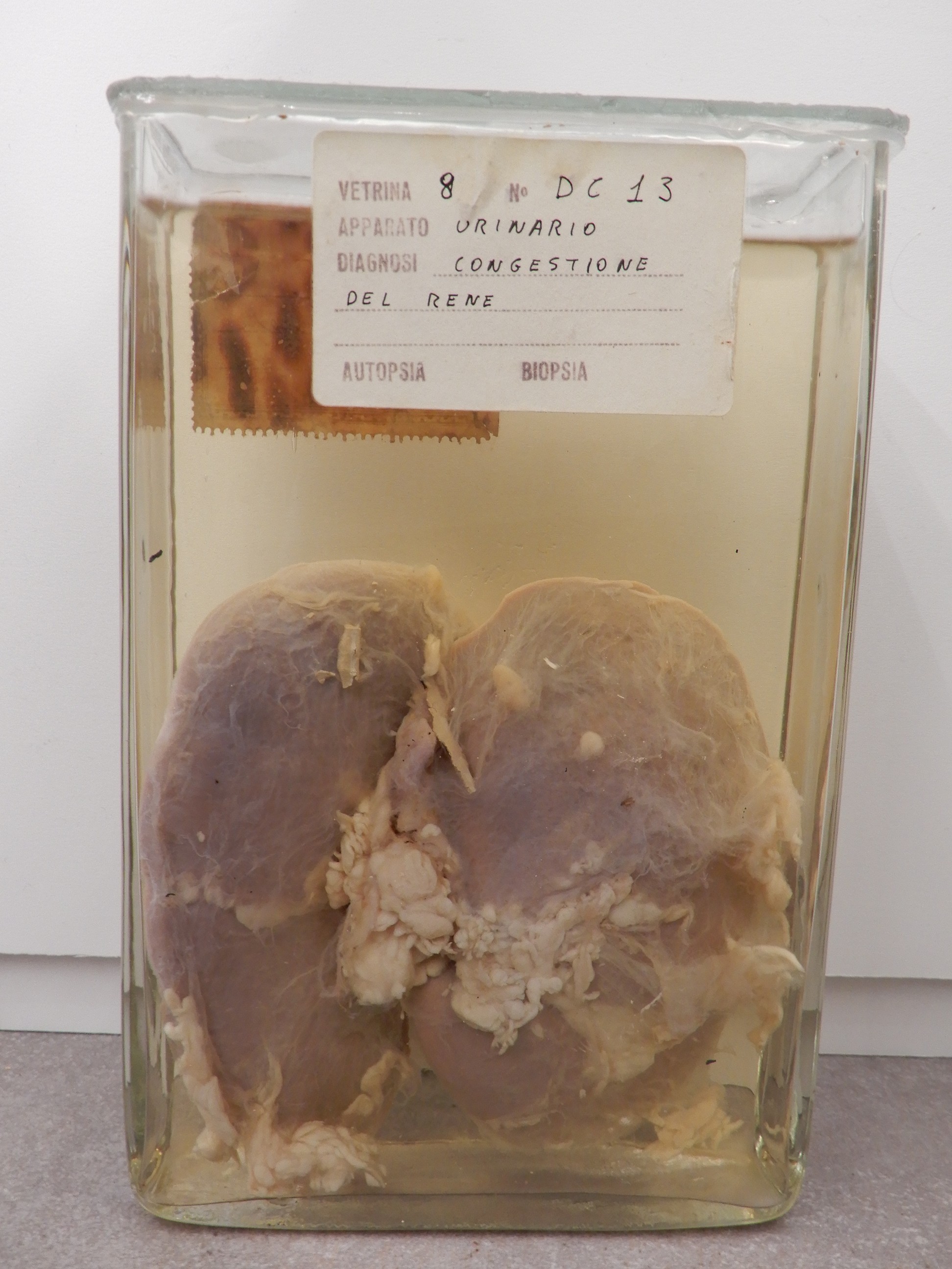 singolo reperto antropologico, preparato anatomico (morfologia alterata per patologia) (XIX-XX)