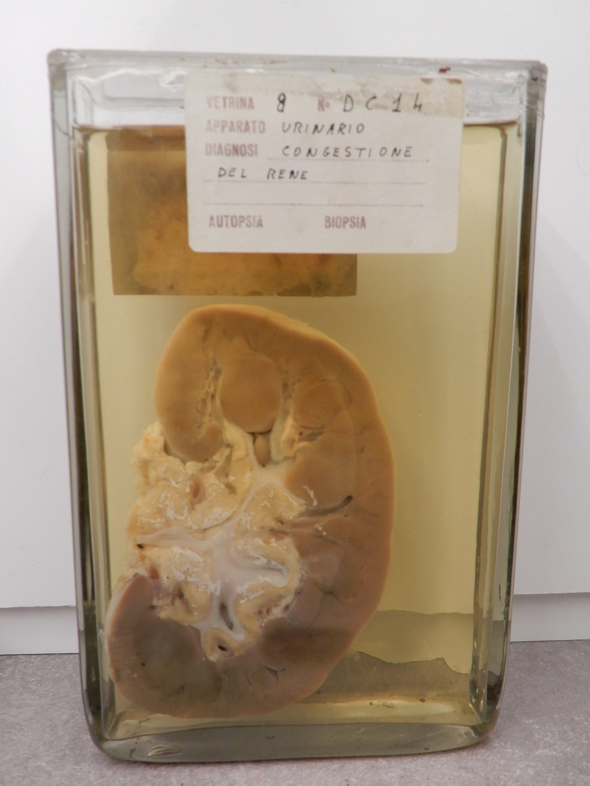 singolo reperto antropologico, preparato anatomico (morfologia alterata per patologia) (XIX-XX)