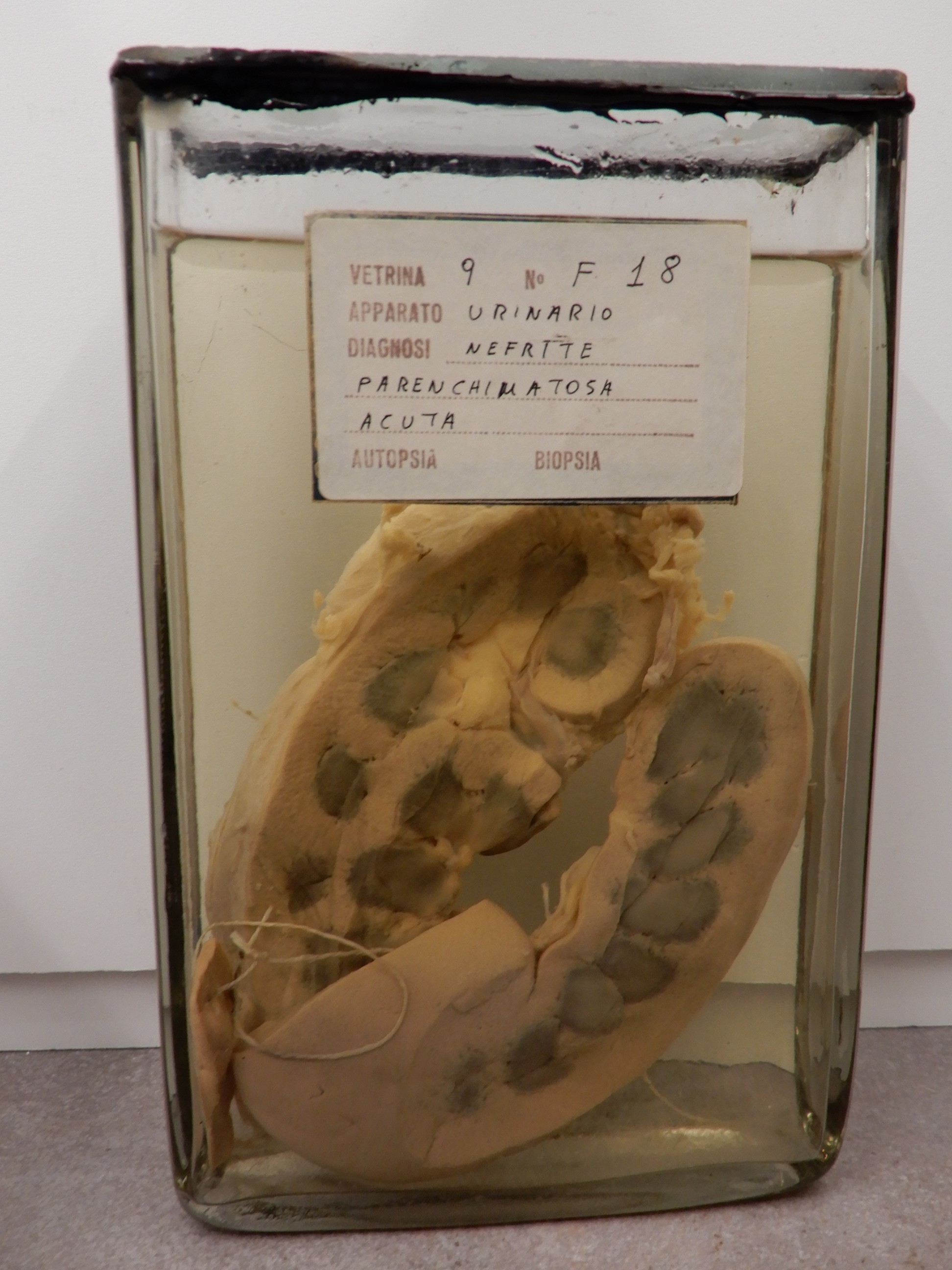 singolo reperto antropologico, preparato anatomico (morfologia alterata per patologia) (XIX-XX)