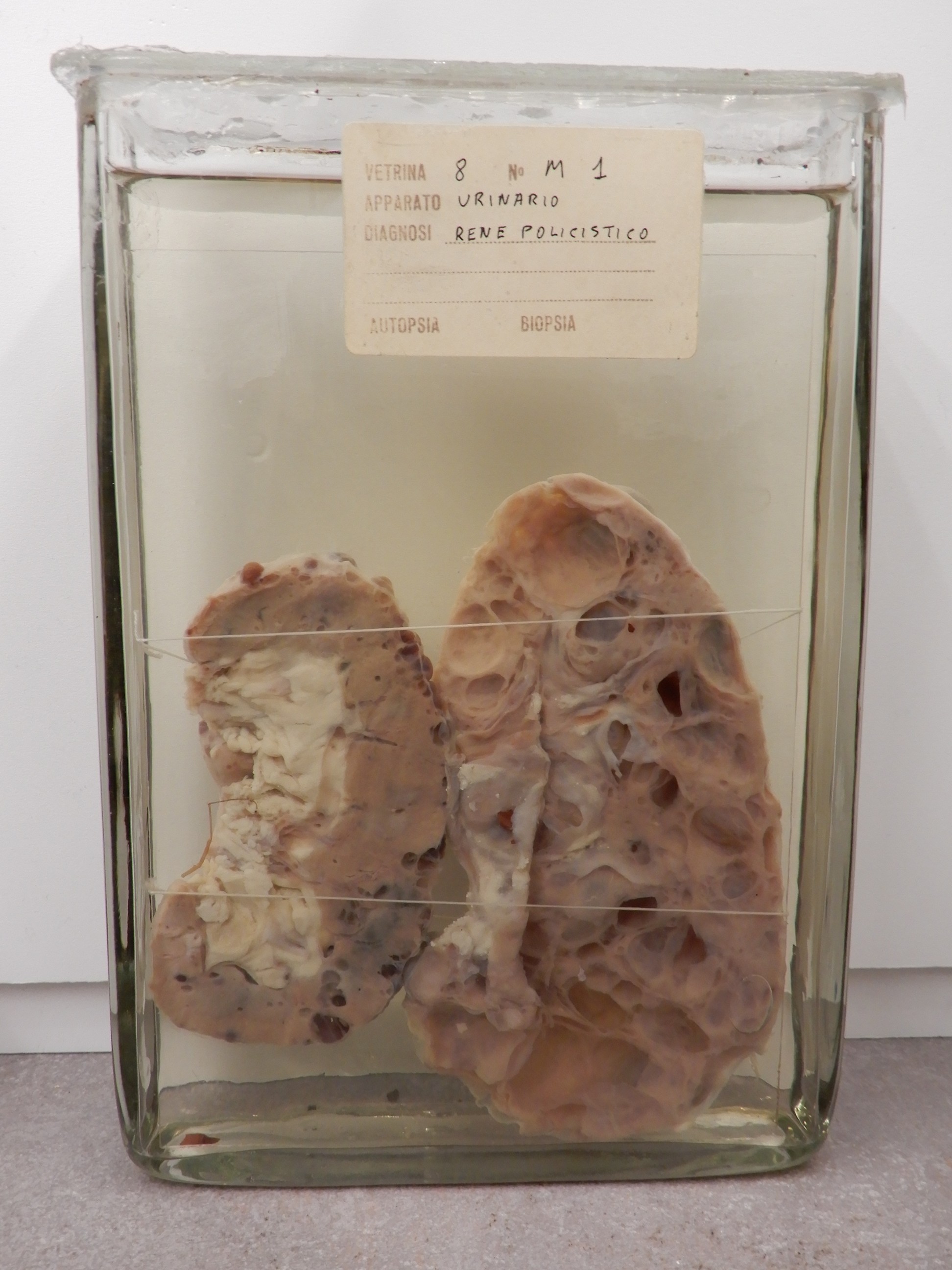 singolo reperto antropologico, preparato anatomico (morfologia alterata per patologia) (XIX-XX)