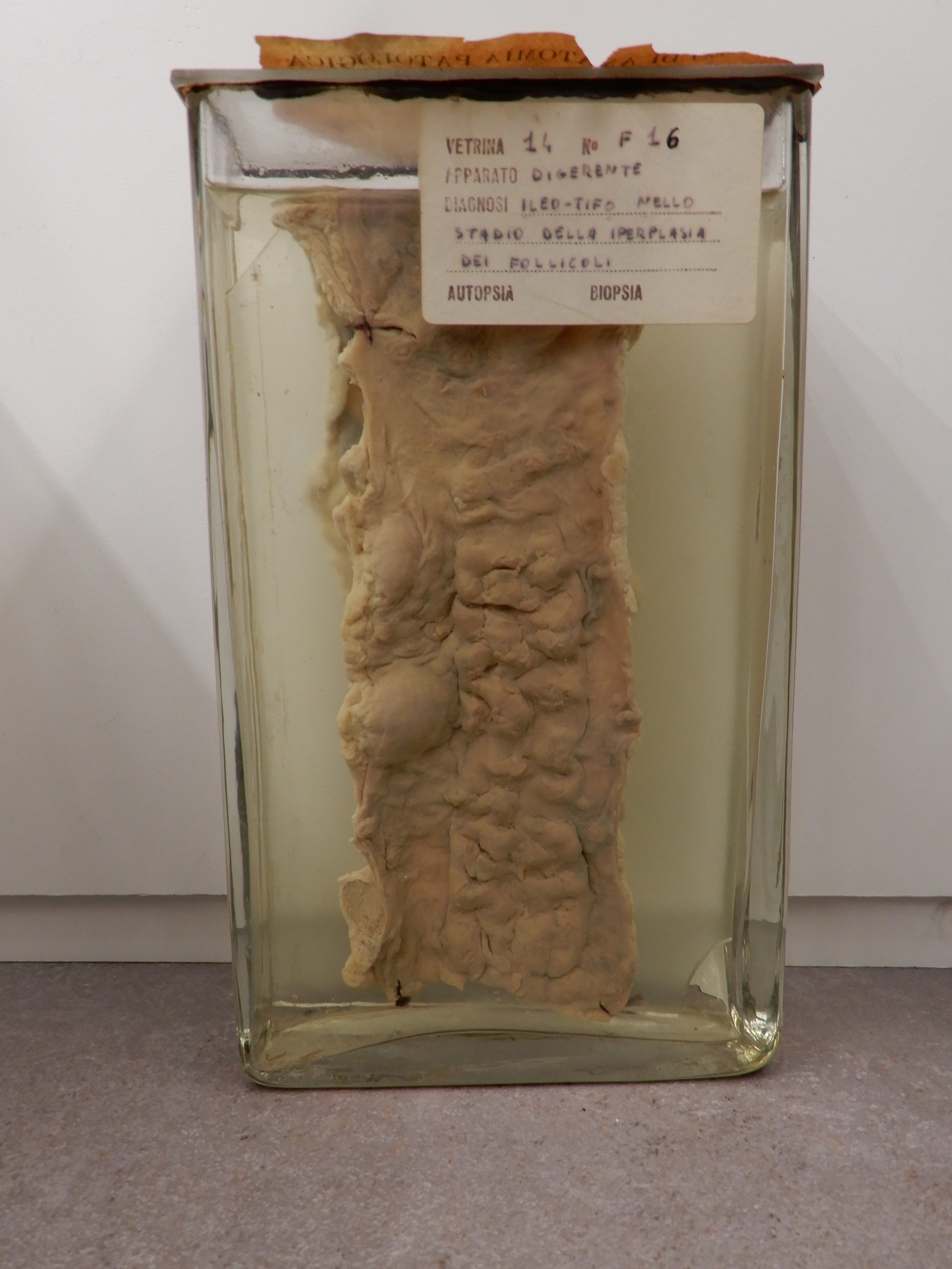 singolo reperto antropologico, preparato anatomico (morfologia alterata per patologia) (XIX-XX)