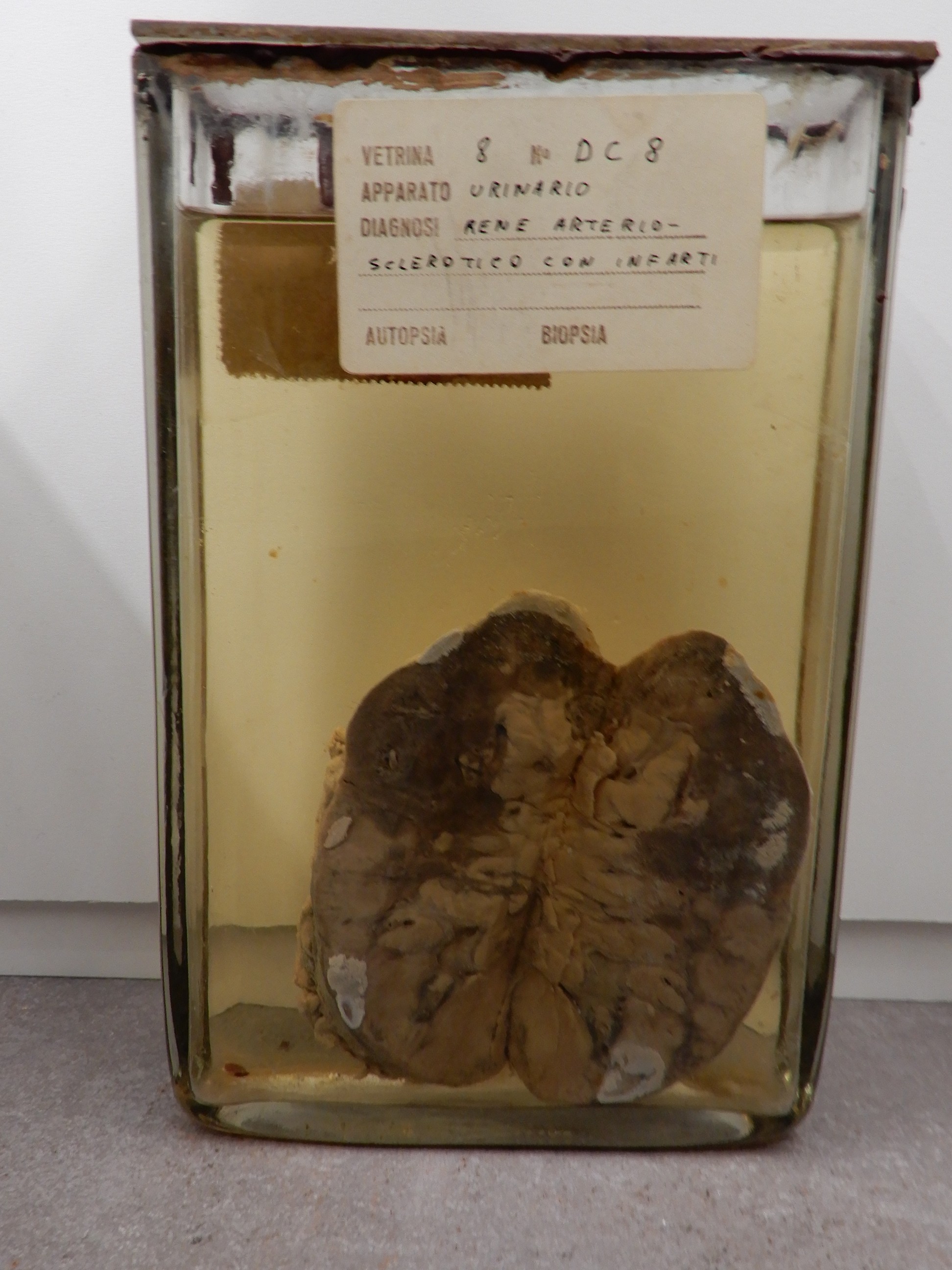 singolo reperto antropologico, preparato anatomico (morfologia alterata per patologia) (XIX-XX)