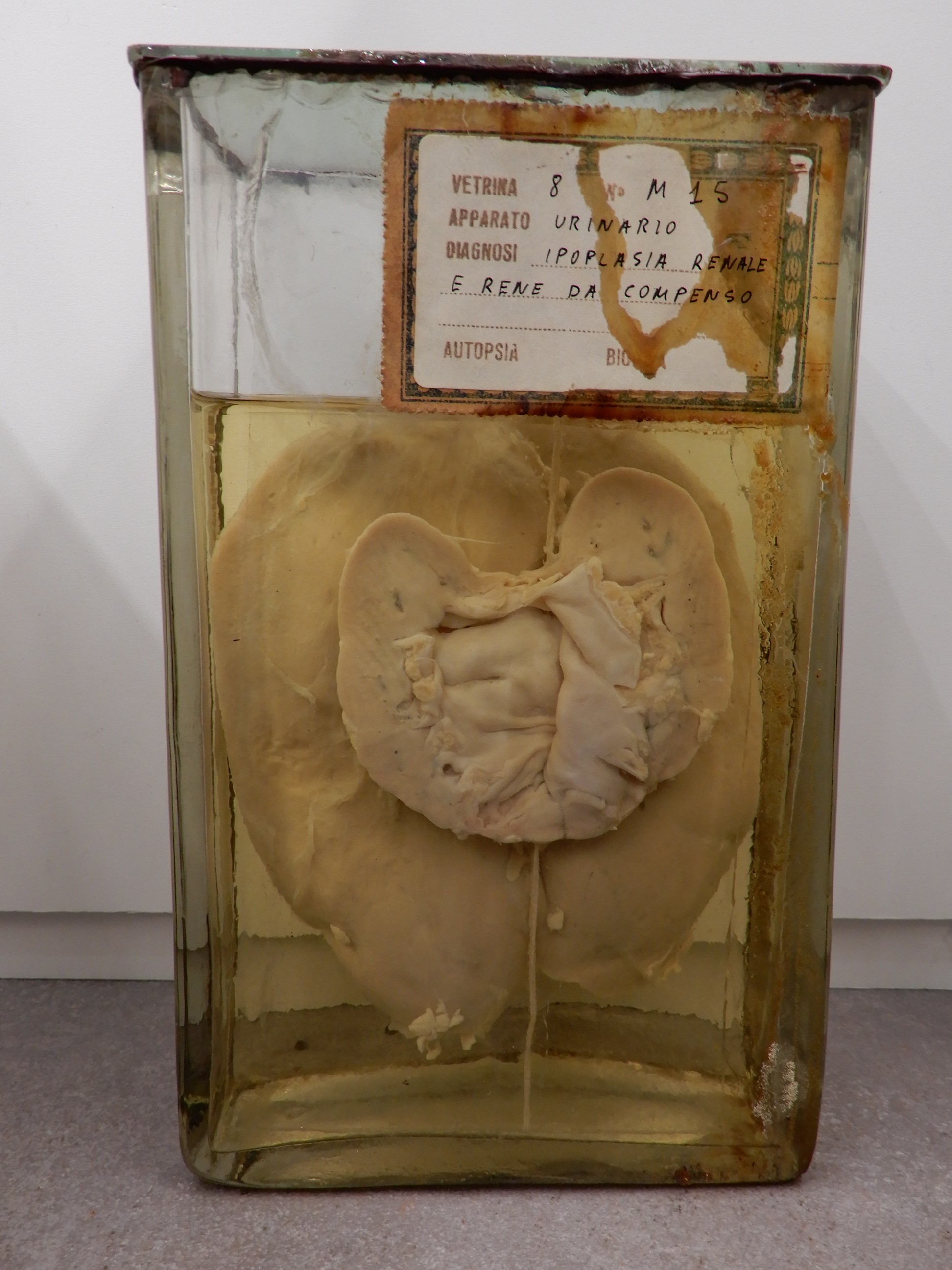 singolo reperto antropologico, preparato anatomico (morfologia alterata per patologia) (XIX-XX)