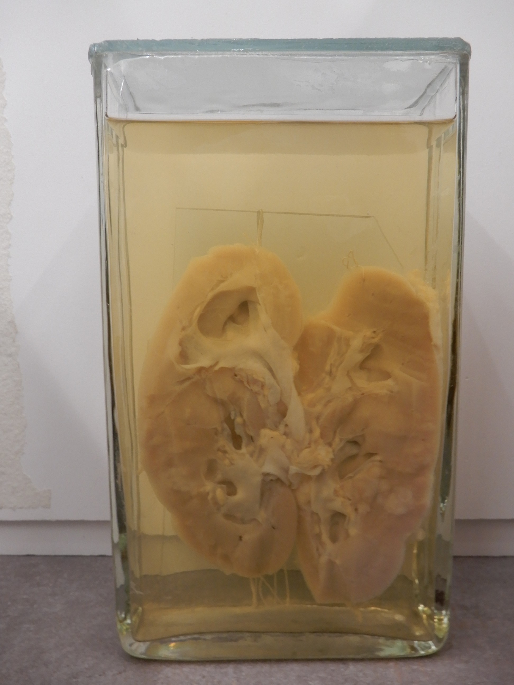 singolo reperto antropologico, preparato anatomico (morfologia alterata per patologia) (XIX-XX)