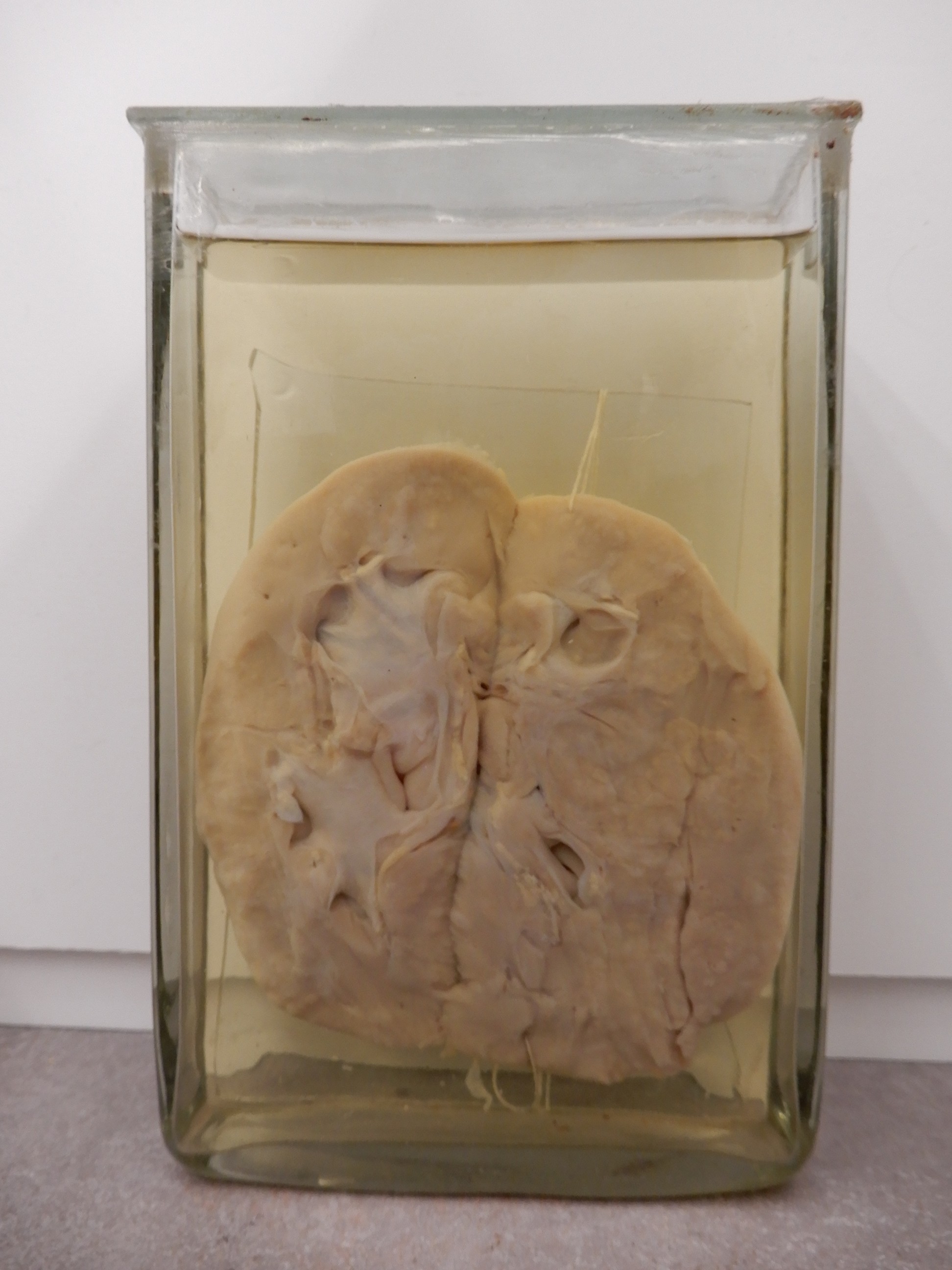 singolo reperto antropologico, preparato anatomico (morfologia alterata per patologia) (XIX-XX)