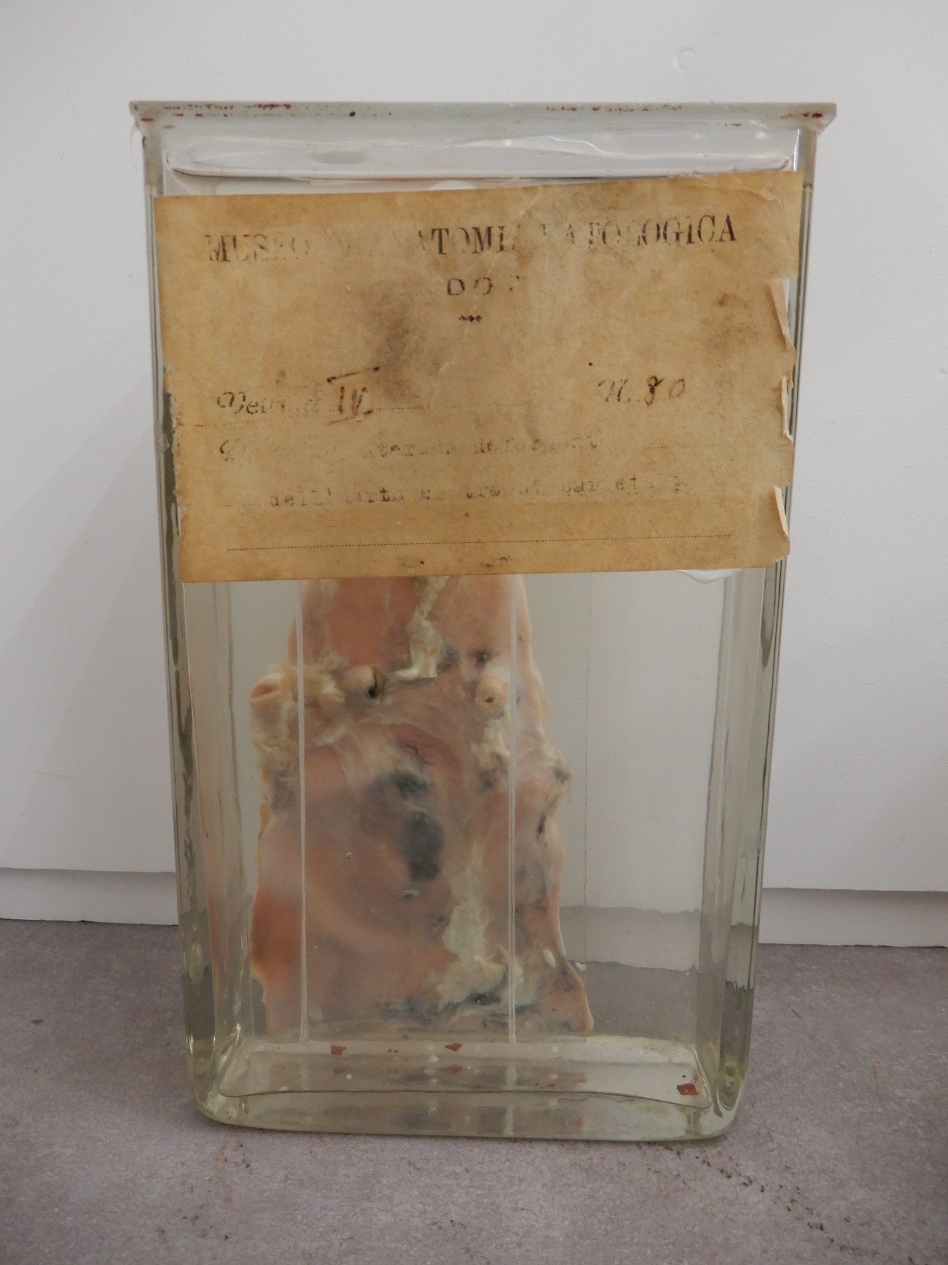 singolo reperto antropologico, preparato anatomico (morfologia alterata per patologia) (XIX-XX)