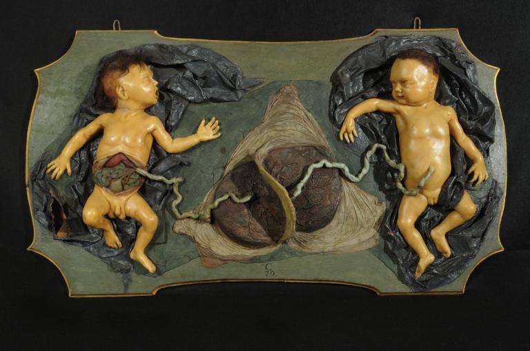 preparato ostetrico, feti gemelli di Toselli Nicola, Toselli Ottavio (sec. XVIII)
