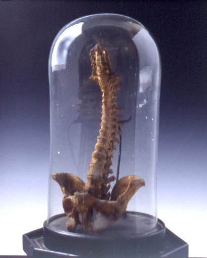 preparato ostetrico, busto osteomalacico (sec. XVIII)