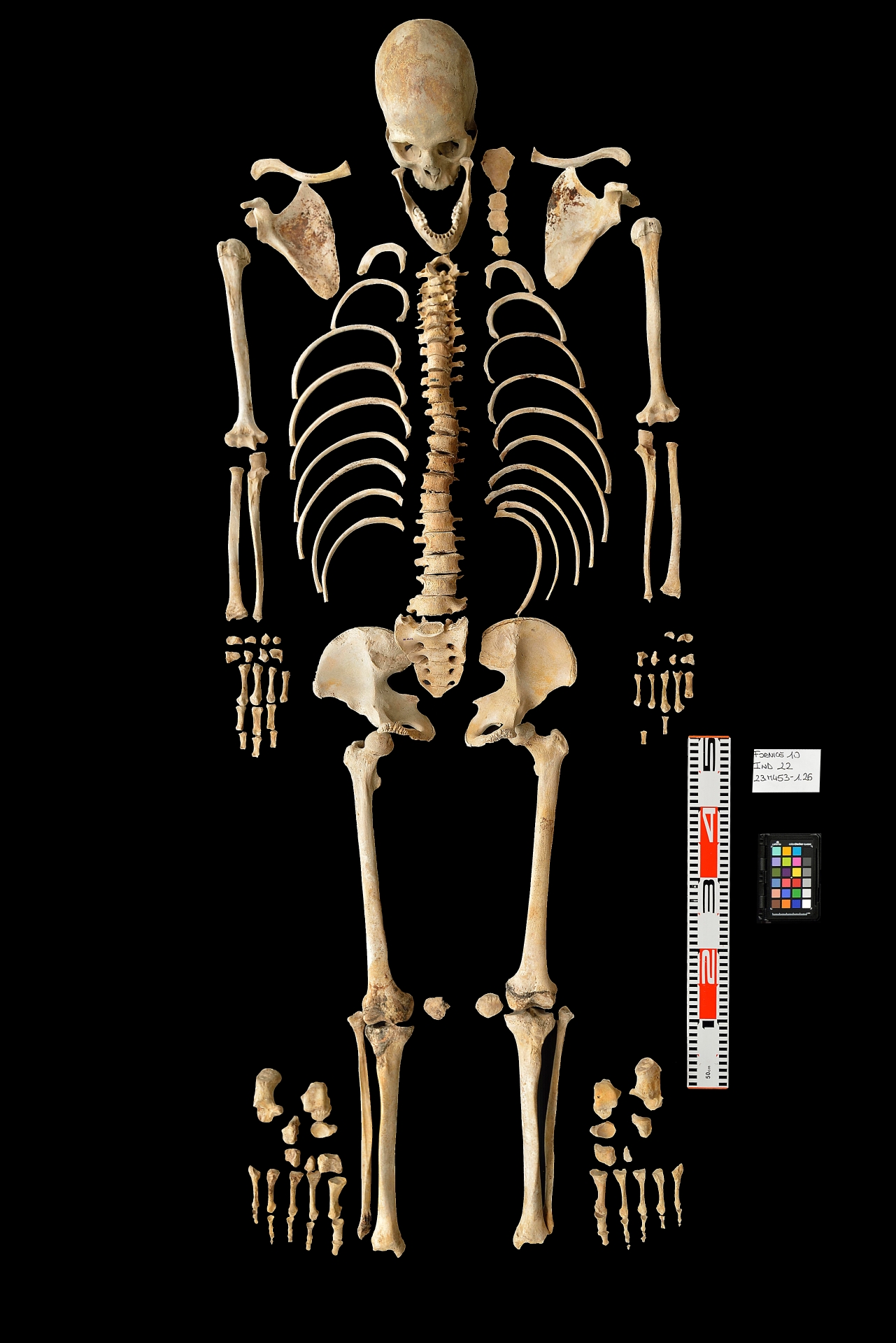 reperti antropologici pertinenti a un unico individuo, reperto osteo dentario (sec. I d.C)